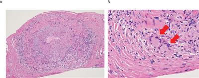 Pathogenic role of monocytes/macrophages in large vessel vasculitis